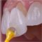 Veneer